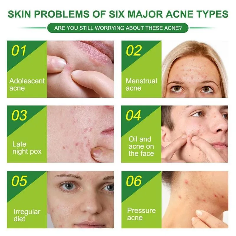 24pcs/sheet Acne Pimple Patch Effectively Treatment Face Skin Blemish Master Invisible Remover Acnes Mask Stickers Beauty Tool