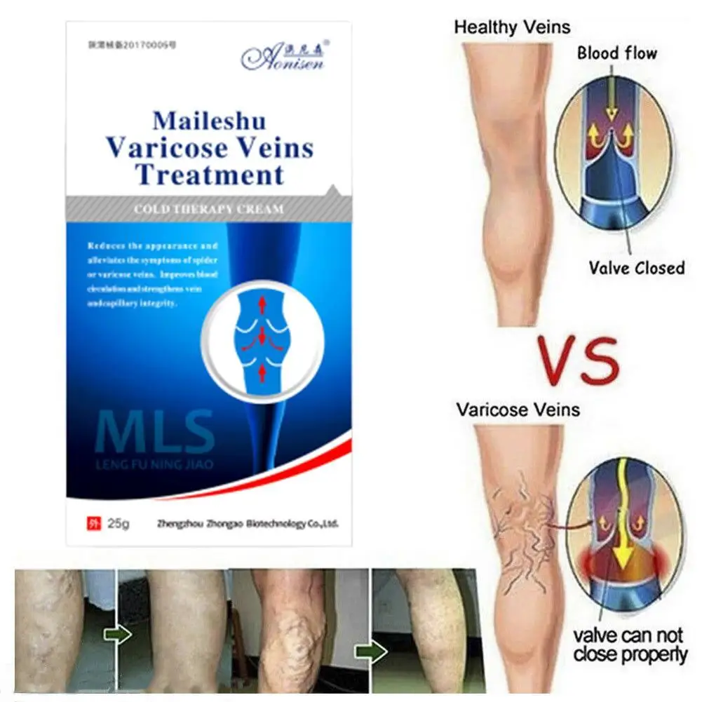 Мазь для лечения варикозного расширения вен эффективное лечение крем ангиита