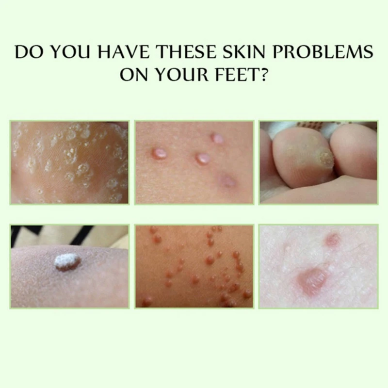 Метка на коже набор для удаления бородавок тела лечение мазь медицинский