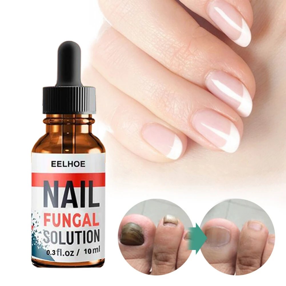 

30ml Fungal Onychomycosis Paronychia Nail Treatment Serum Anti-Fungal Nail Infection Herbal Toe Fungus Foot Repair Essence Care