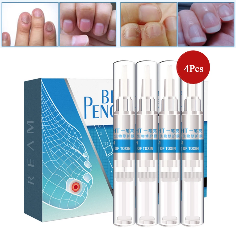 3 мл китайская медицина травы Лечение грибка ног ногтя против грибкового