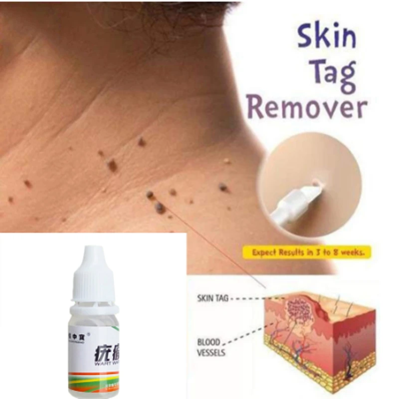 Крем для ухода за телом средство удаления метка на коже мозолей растительные