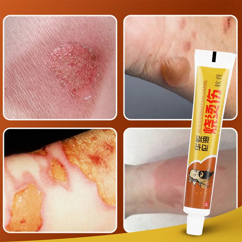 25 г мазь для снятия ожогов Антибактериальная Lithospermum китайская травяная кипящая