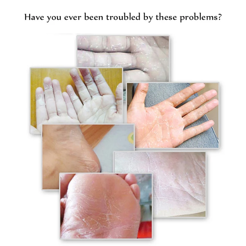 

Hot Cracked Heel Cream For Rough Dry Cracked Chapped Feet Remove Dead Skin Soften Foot Care