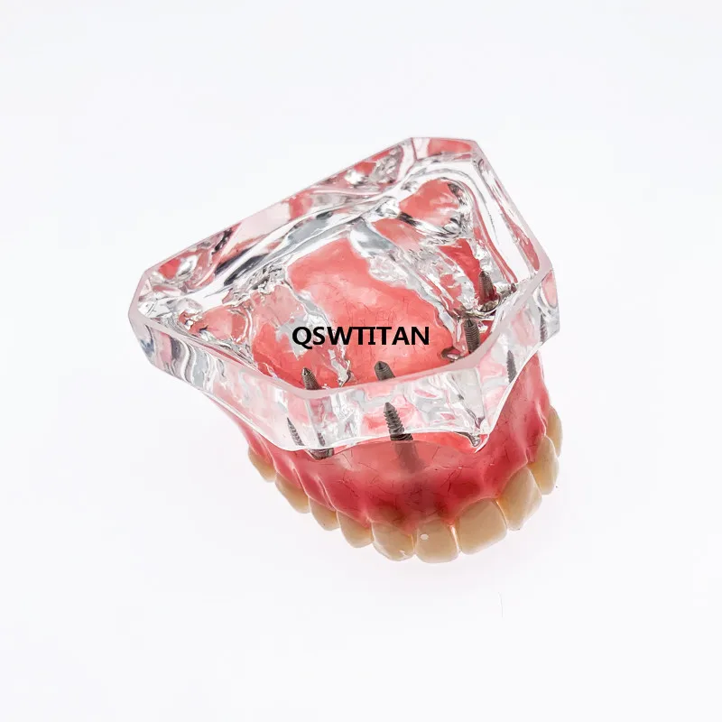 Стоматологическая модель зубов верхняя челюсть улучшенный протез с 4 имплантами