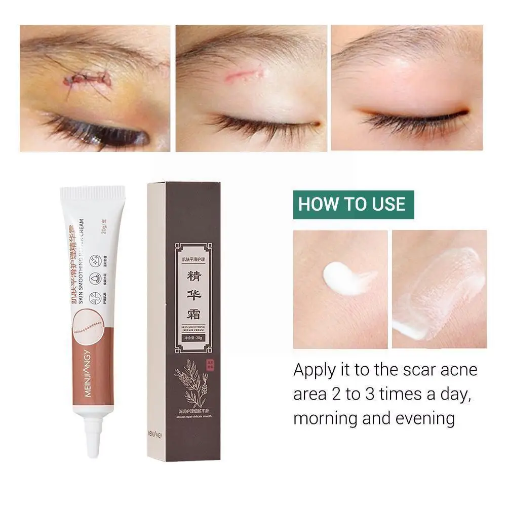 

20g Acne Scar Removal Cream Scar Gel Skin Repair Face Treatment Acne Spots Cream Acne Care Marks Stretch Whitening Skin N9j4