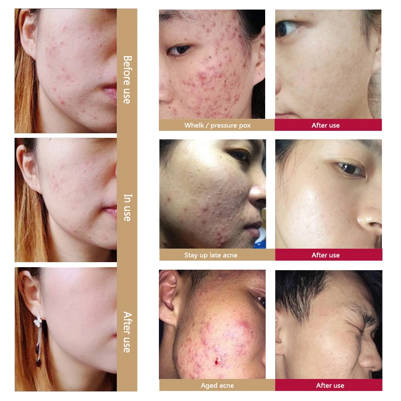 Herbal Acne Remove Pimple Oil-control Serum Shrink Pores Fade Printing and Repair Face Centella Blain Serum Skincare TXTB1