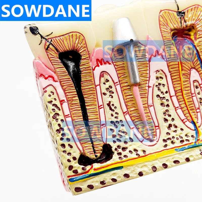 Зубные протезы модель обычной патологии обучающая зубной Стоматолог для изучения медицины