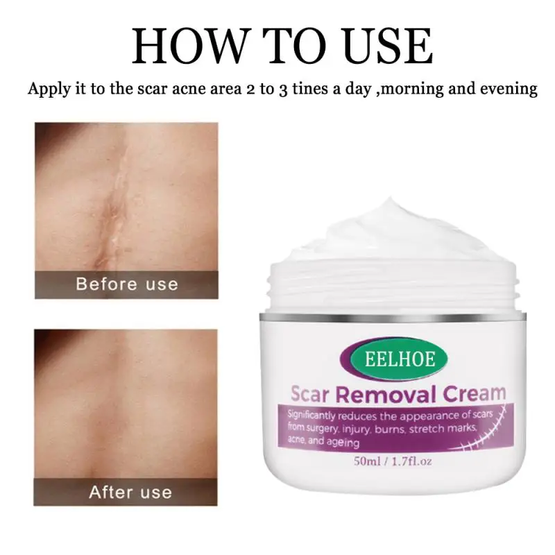 Восстанавливающий шрам крем для удаления шрамов кесарева хирургии уменьшения