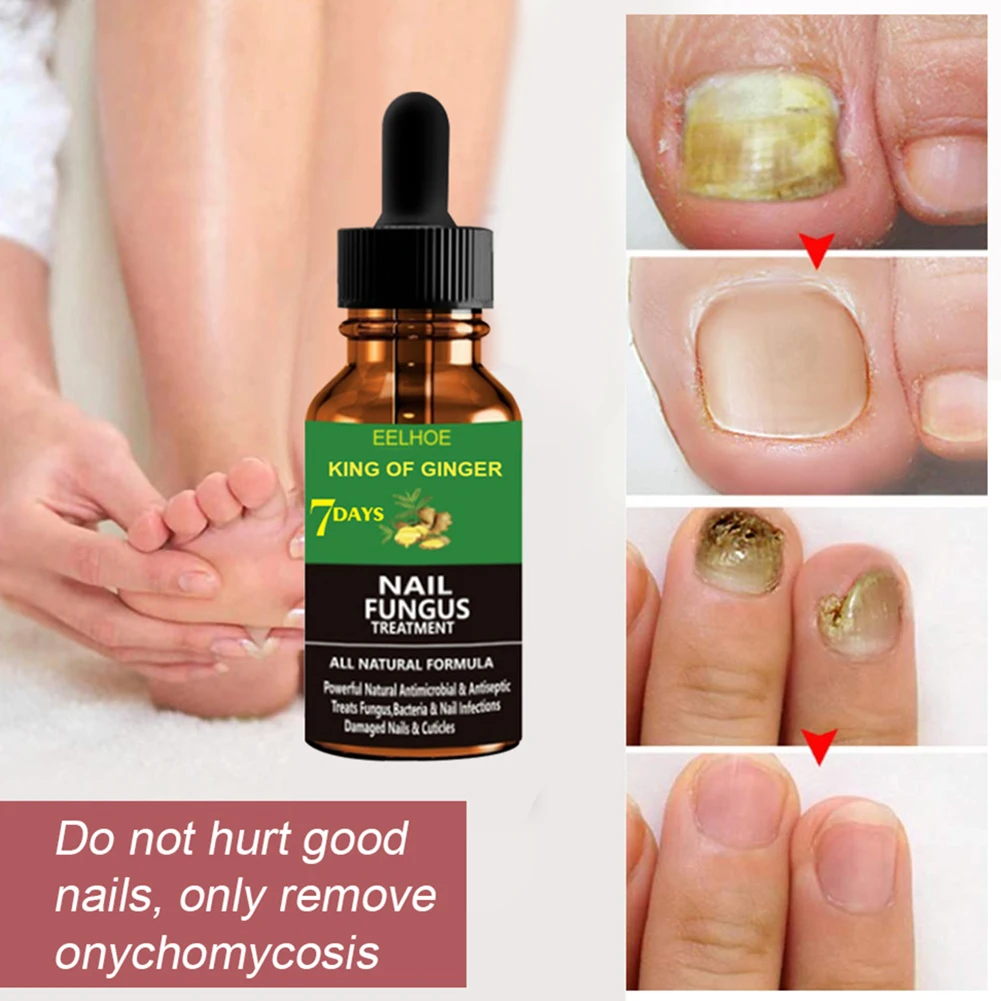 

1PC 20ml Nail Repair Liquid Essence Fungus Treatment for Fingernails Toenails Improves the Appearance