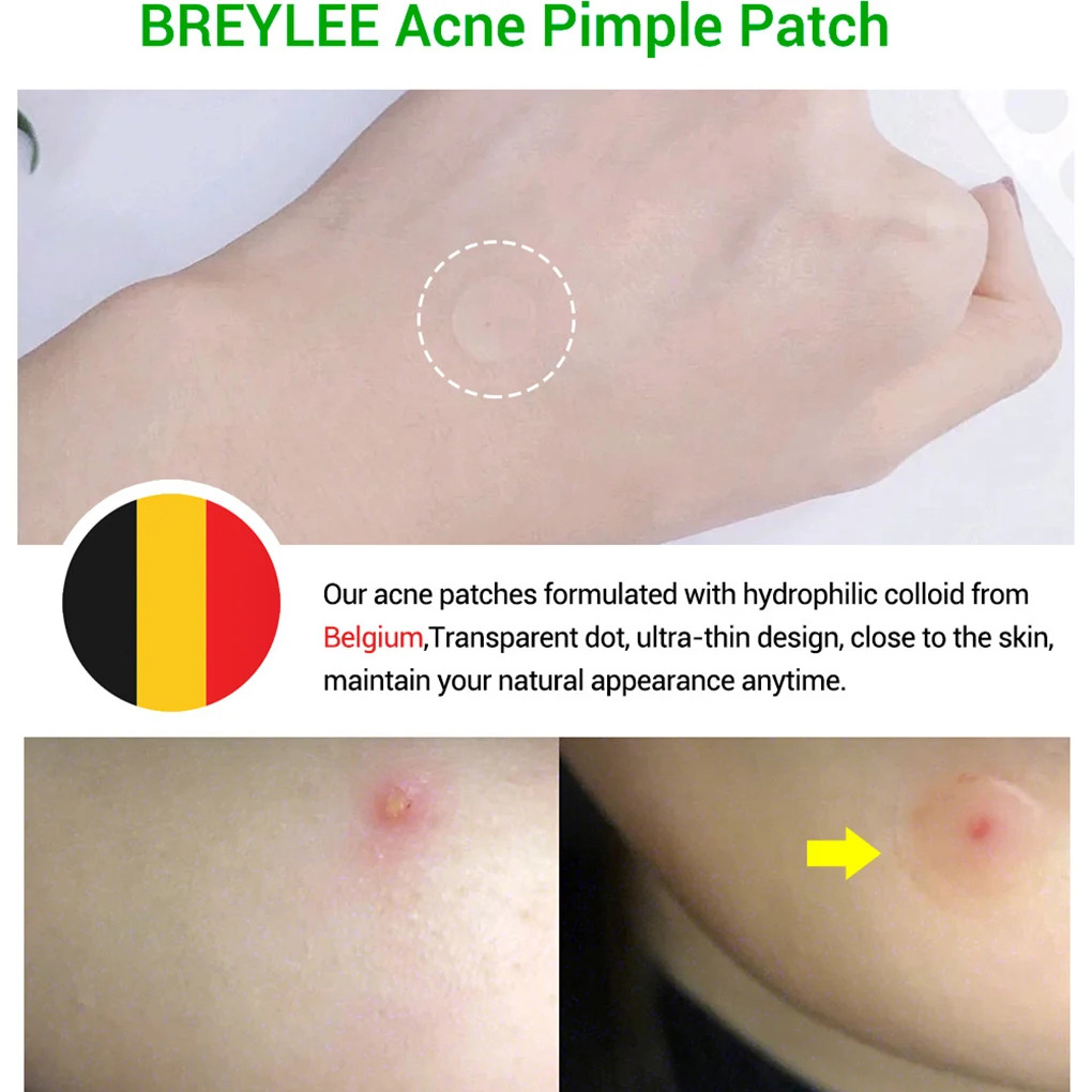 BREYLEE Acne Pimple Patch Treatment Stickers Remover Tool Blemish Spot Skin Care Face Mask Cream Daily Use | Красота и здоровье
