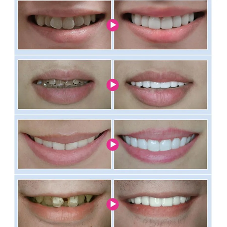 Стоматологическое оборудование стандартное отбеливание зубов 44% пероксидная