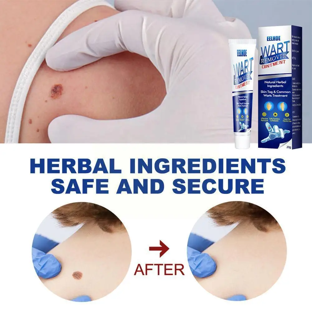

1/3 Pcs Instant Portable Blemish Removal Gel Wart Removal Skin Care Tag Wart Treatment Cream Cream Cream Body Remover Warts O4K6