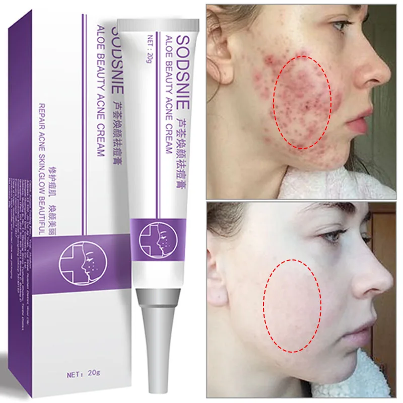 

Aloe Effective Acne Removal Cream Anti-Acne Treatment Fade Acne Spots Oil Control Shrink Pores Whitening Moisturizing Skin Care