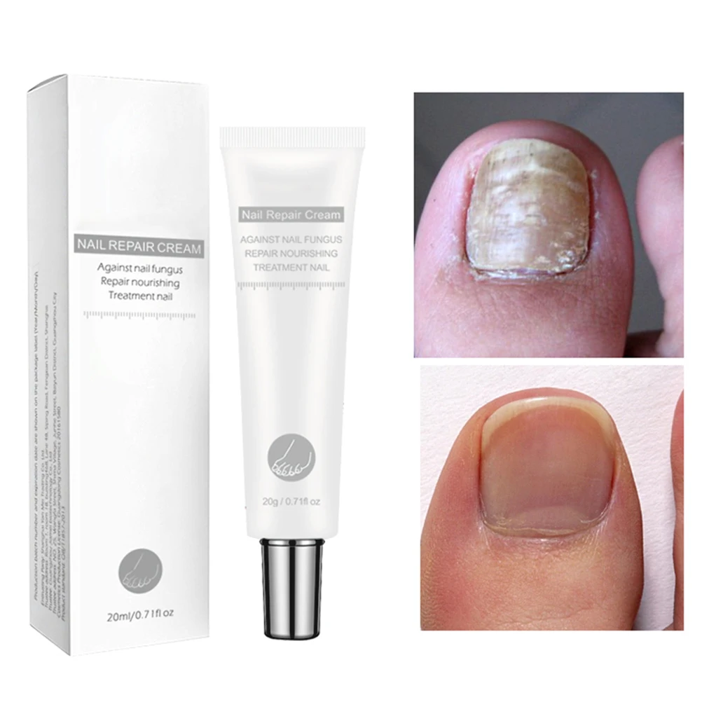 20g Nail Fungus Treatment Cream Onychomycosis Paronychia Anti Fungal Infection Kills Bacteria And | Красота и здоровье