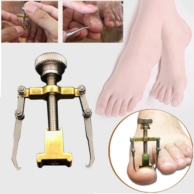 Ingrown Toenails Pedicure Foot Nail Care Tools File for Feet Orthotic Acronyx Ingrowing Onyxis Bunion Corrector Massage |