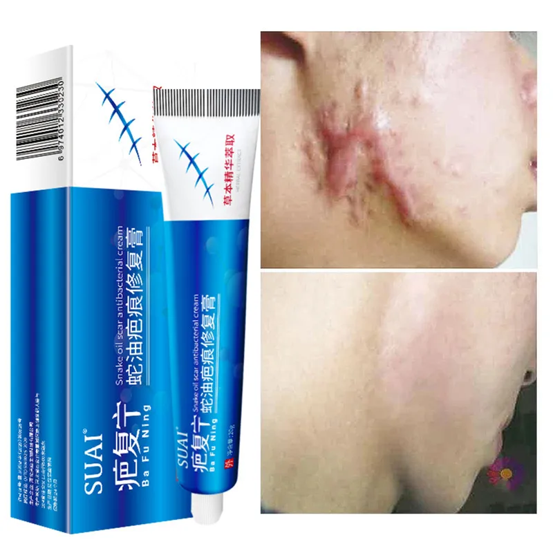 

20g Acne Scar Removal Cream Pimples Stretch Marks Face Gel Remove Acne Smoothing Whitening Moisturizing Body Skin Care