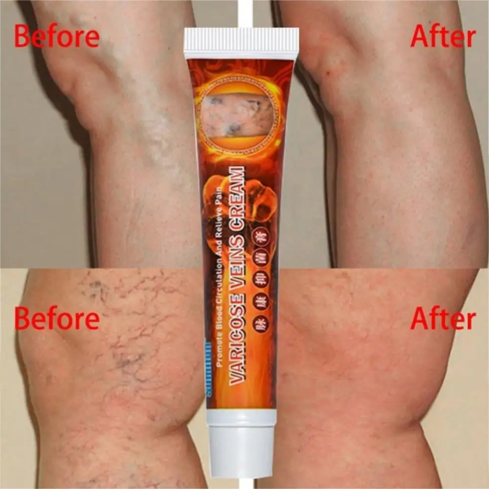 

20 г варикозное расширение вен лечение крем для варикоза ангиит мазь рельеф вен боли флебит медицинский пластырь для здоровья