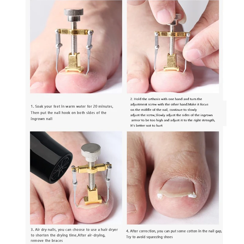 

Коррекция вросших ногтей на ногах, педикюр, инструменты для ухода за ногтями, выпрямляющий зажим, корректор, вросший палец фиксатор для ногт...