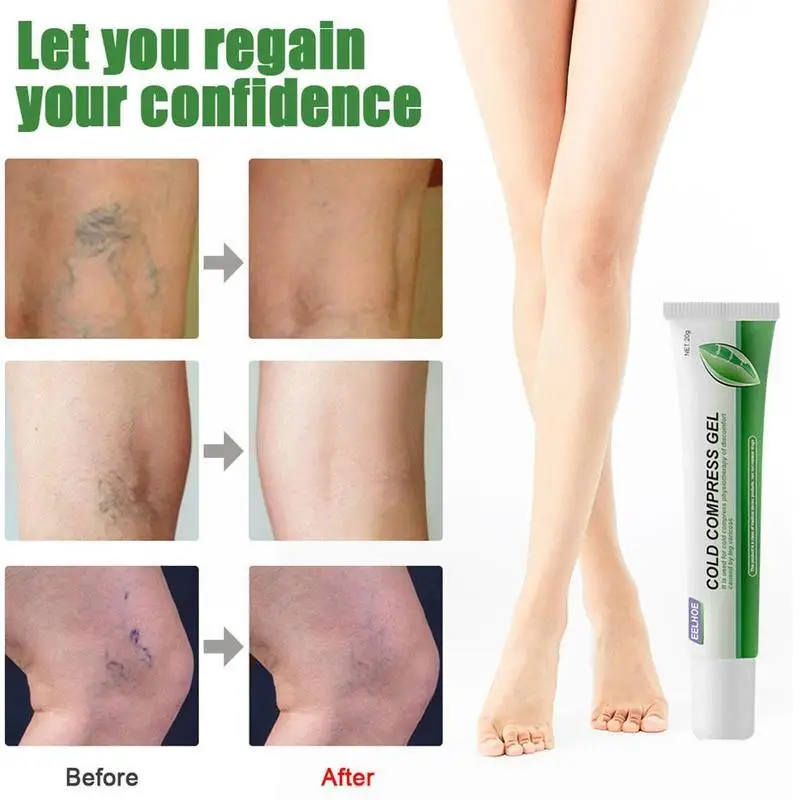 Гель для варикозного расширения вен и лечебная ручка эффективное облегчение