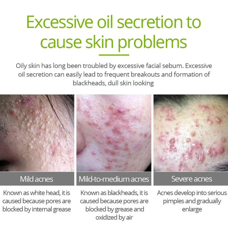 Чистый натуральный Чай дерево лица Сыворотки яркие угревой сыпи выдвижной поры