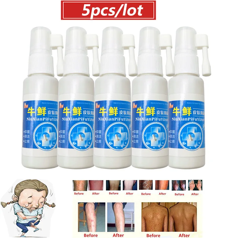 5 шт./лот мазь для облегчения кожи мазь-спрей псориаси экзма китайский