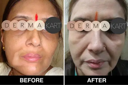 Точечный оригинальный моно бензо BB отбеливающий крем монобензон бенокиновый 20% 30