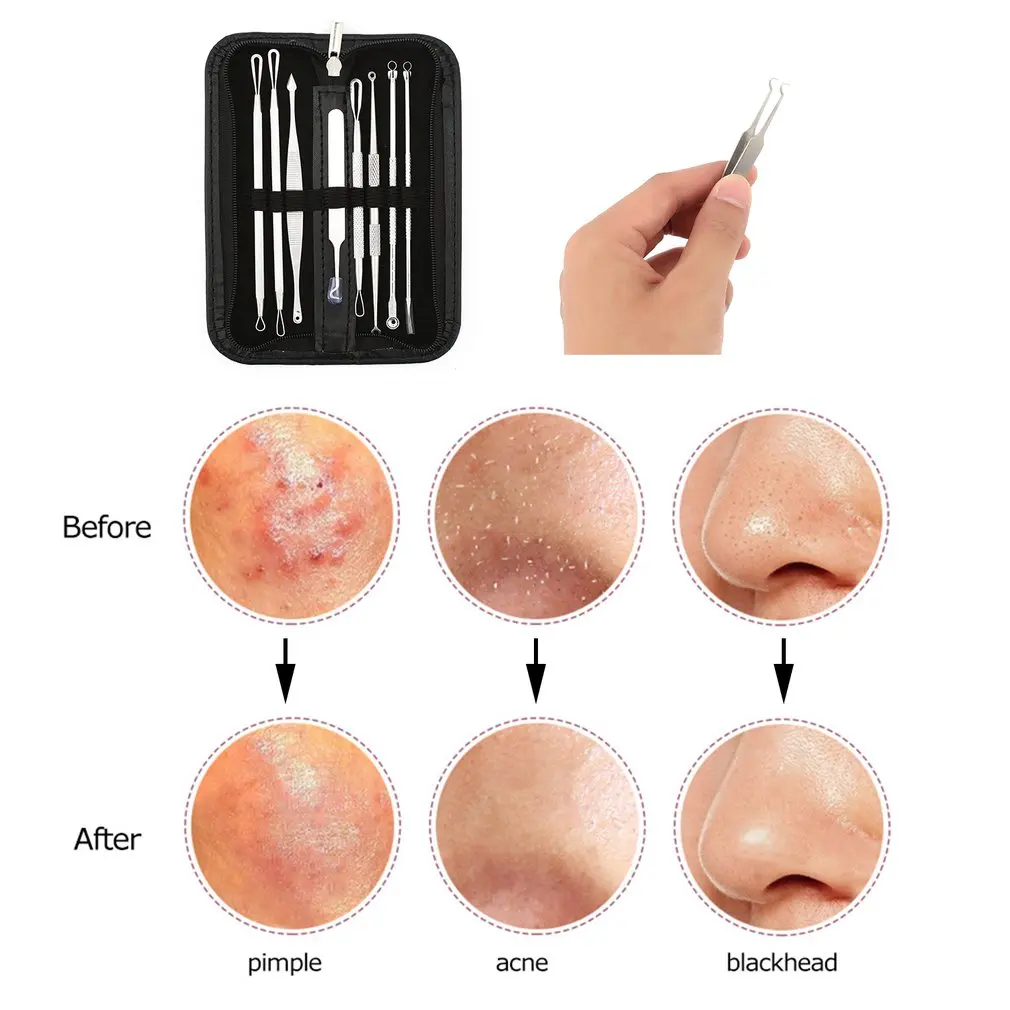 8 Pcs Blackhead Remover Tool Kit Pimple Acne Clip Needle Face Care Comedone Blemish Blackhead Extractor Tool with Leather Case