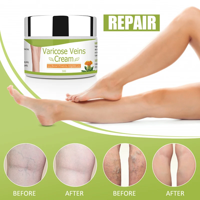 

50g Organic Healing Cream for Varicose Vein Varicose Cream Swelling Veins Treatment Leg Care Supplies for Adults Health Care