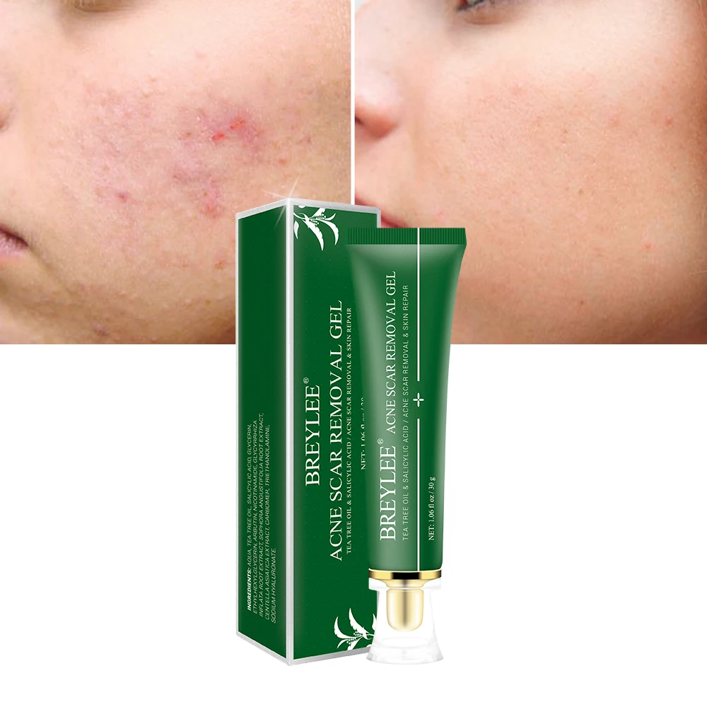 

BREYLEE 30g Effective Weakening Acne Scar Removal Gel Fade Acne Remove Skin Pigmentation Soothing Prevent whiten Acne Treatment