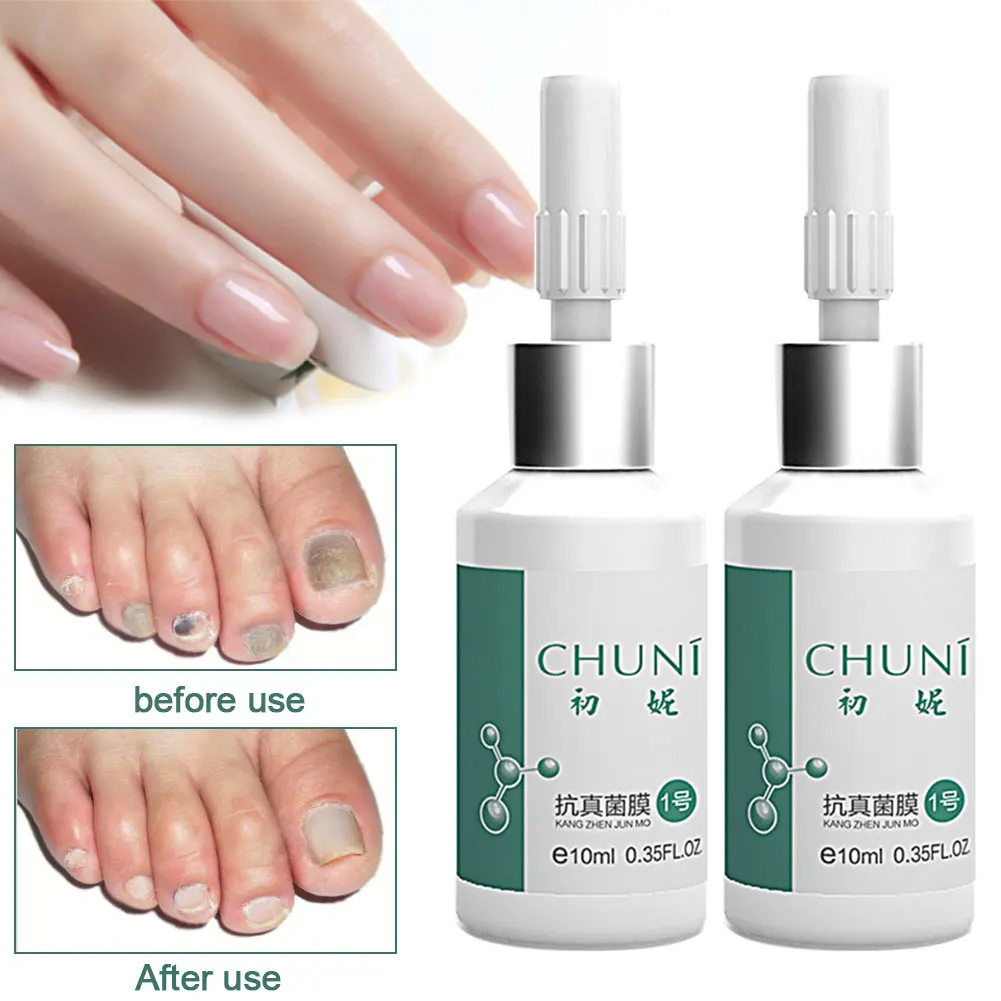 20 мл Ringworm Портативный Клей для ремонта ногтей ускоряет лечение роста Relustering