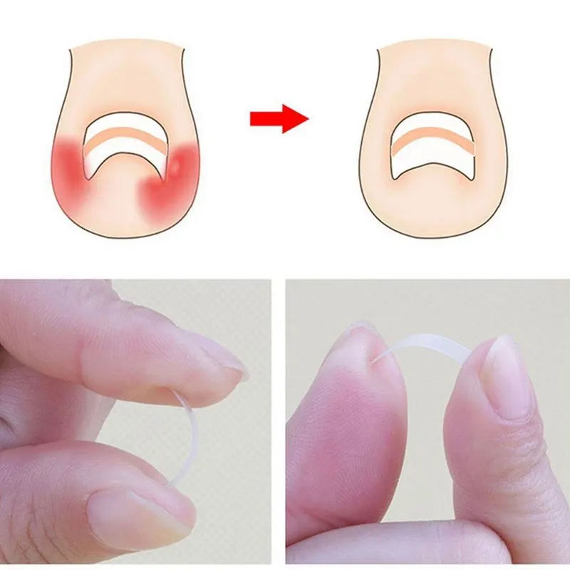 10 шт./компл. BYEPAIN ToeNail Art коррекция вросших наклеек фиксатор Paronychia