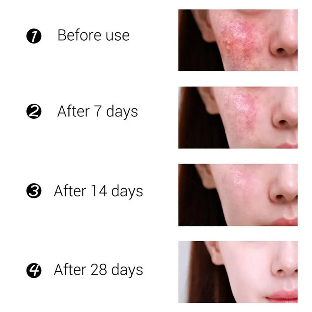 

Fades Acne Marks And Acne Moisturizing Acne Cream Acne Face Repair Products Oil Control Shrink Pores Whitening Acne Cream