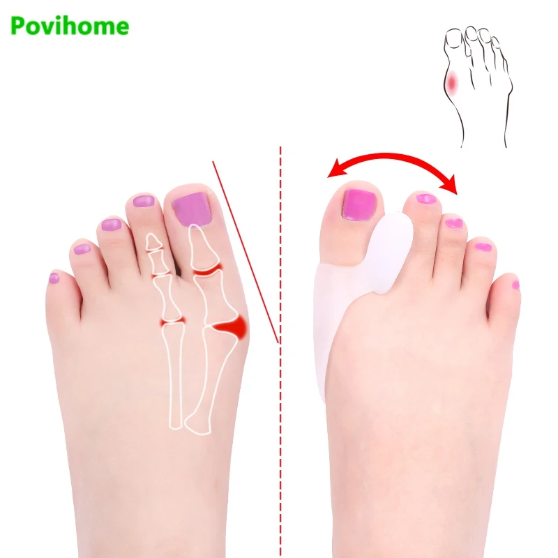 

4pcs Silicone Gel Foot PadGel Bunion Big Toe Separator Alignment Toe Bone Insole Thumb Pain Foot Hallux Valgus Correction C147