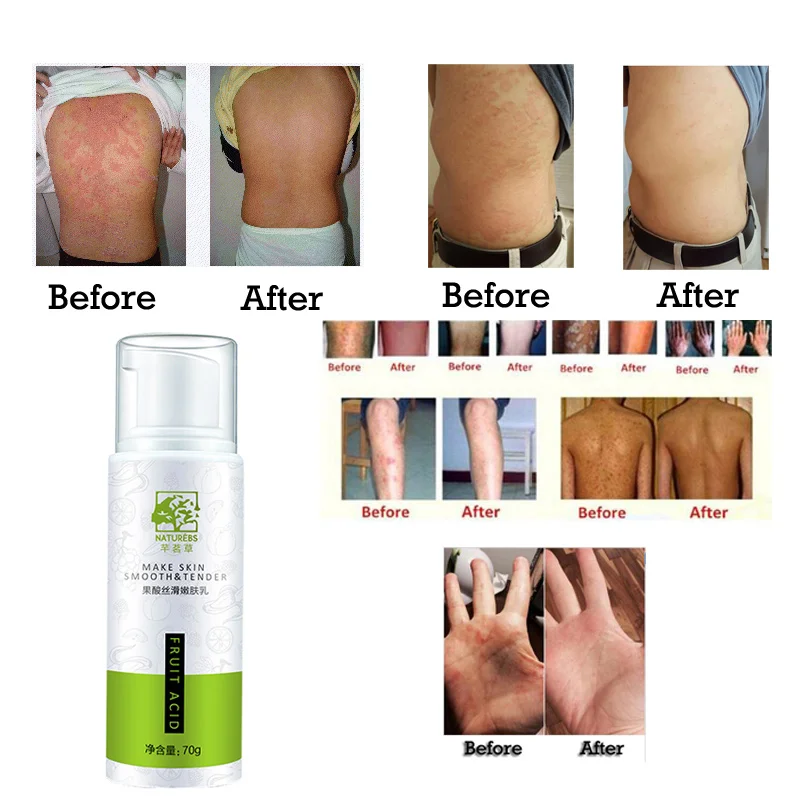 WXE 100% натуральные фруктовые кислоты лосьоны крем отбеливающий сильный