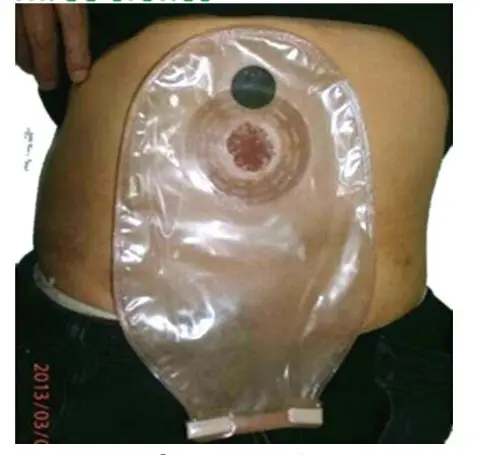 Один одноразовый мешок для стомии с дренажом (классический пакет стомы)|Брекеты и