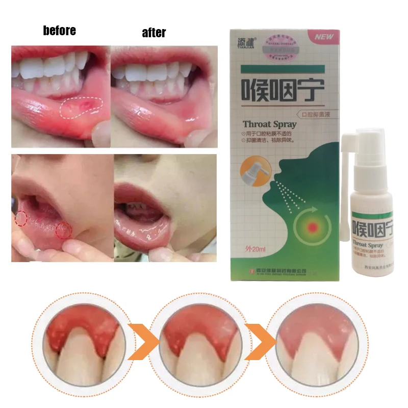 

20ML Houyanning Oral Spray Bacteriostatic Liquid Is Used For Oral Mucosal Discomfort Bacteriostatic Cleaning And Removing Odor