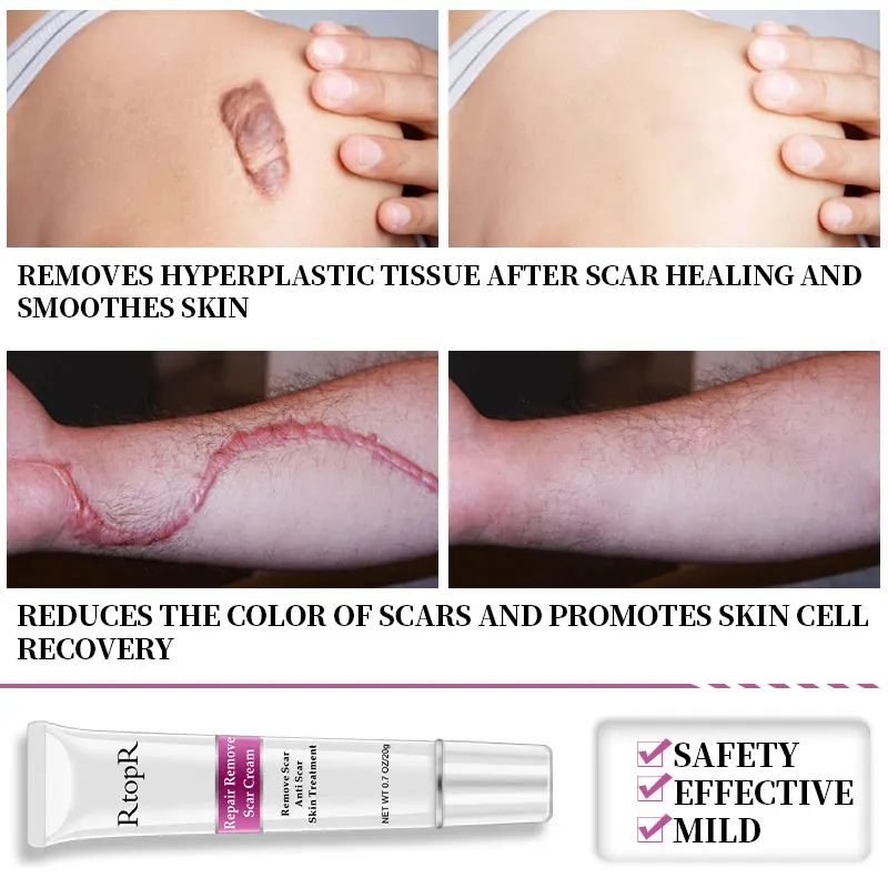 20G Remover Cream Acne Scar Stretch Marks Skin Repair Face Cream Acne Spots Acne Treatment Blackhead Whitening Cream Skin Care