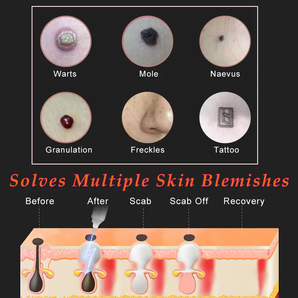 

Laser Mole Removal Pen Wart LCD Remover Tool Beauty Care Skin Corn Freckle Tag Nevus Dark Age Sweep Spot Tattoo Electric Machine