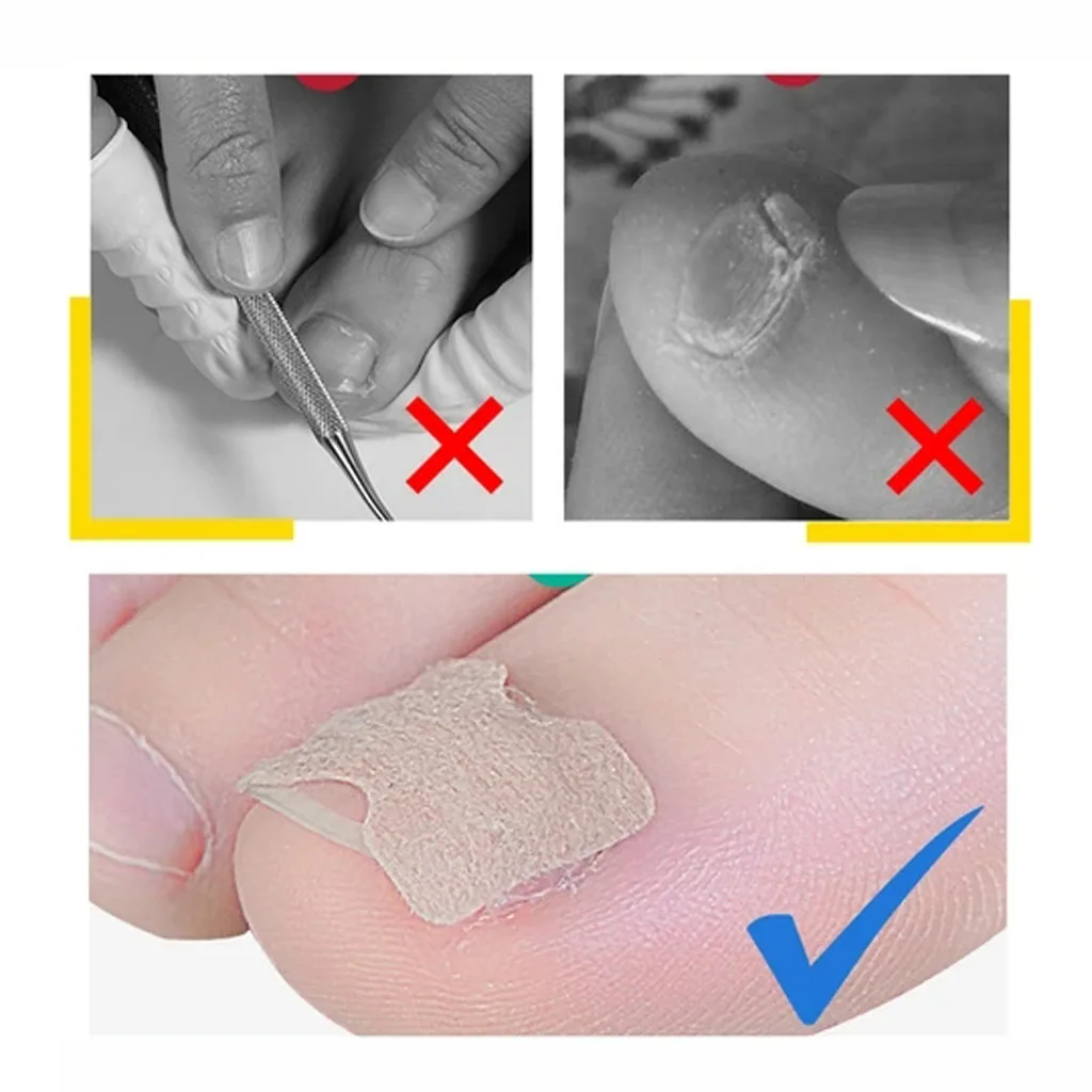 5pcs Glue Free Ingrown Toenail Patch Set Correction Pedicure Tools Inlay Nail Corrector Stickers Foot Care |