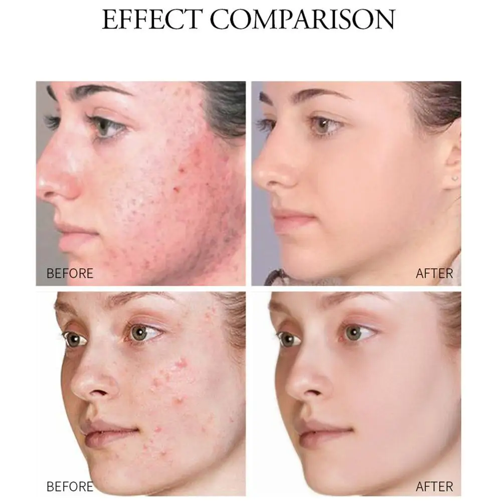 

15ml Salicylic Acid Acne Pen Herbal Acne Moisturizing To Fade Acne Marks And Repair Acne Scar Cream Acne Cleansing Gel