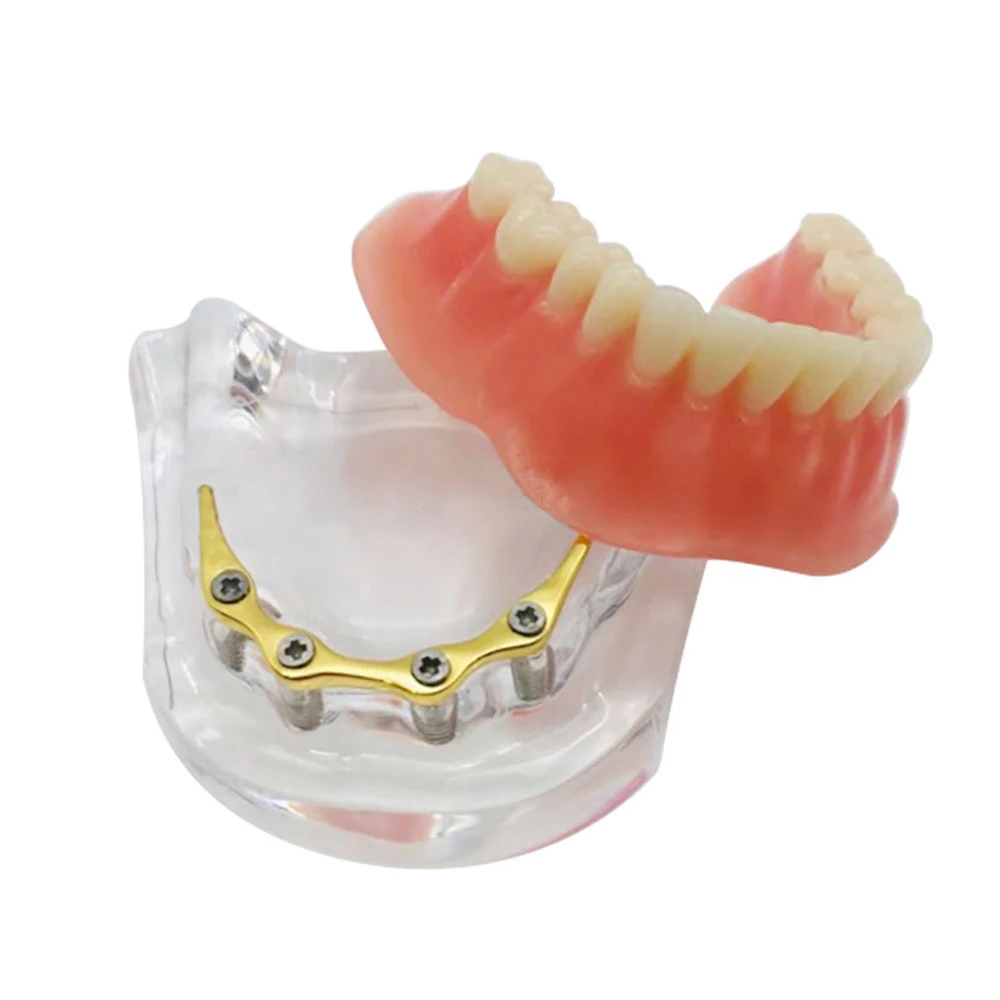 

1pcs Dental Implant Restoration Model With Golden Metal Rod 4 Planting Nails Student Learning Teaching Model