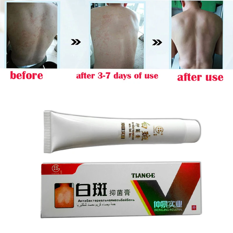 Китайский медицинский крем с белыми пятнами пигмент меланин стимулирующий