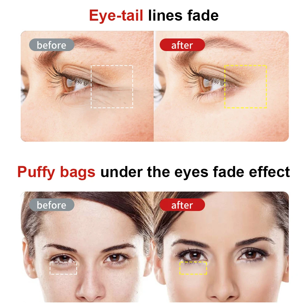 

EMS RF Radio Frequency Face Skin Care Eye Massager Rejuvenation Wrinkle Removal Lifting Tightening Facial Massage Beauty Machine