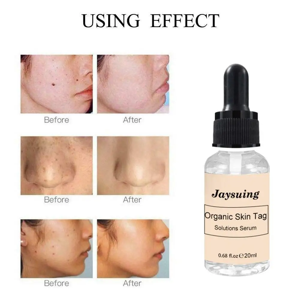 

VIBRANT GLAMOUR 10/20ML Organic Tags Solutions Serum Mole Skin Tag Removal Solution Painless Spots Remover