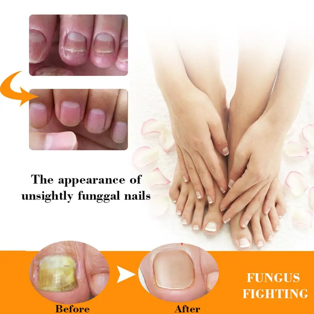 Средство для лечения Ногтей грибок ногтей крем удаления кутикулы масло