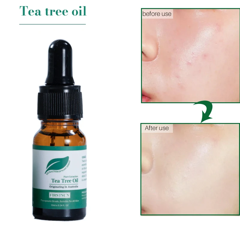 

100% Pure Natural Tea Tree Essential Oils Acne Treatment Beauty Health Anti Stress Oil Aromatic Diffuser Shrink Pores Skin Care
