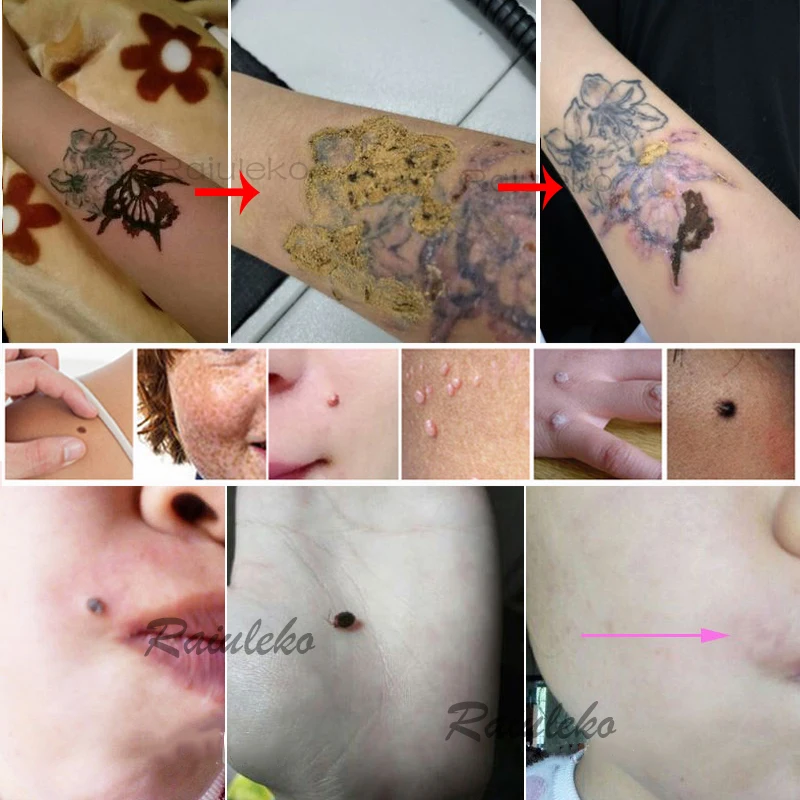 Жидкокристаллический аппарат для удаления темных пятен плазменная ручка