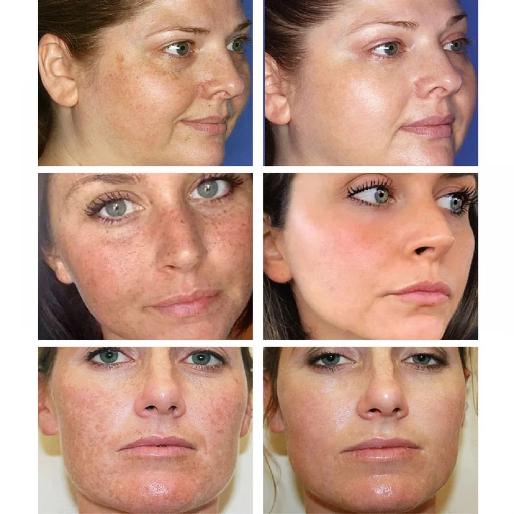 Effective Blemish Cream Pure Skin Anti Aging Freckles Moisturzing Acne Pimple Scar Dark Spots Removal Care Whitening | Красота и