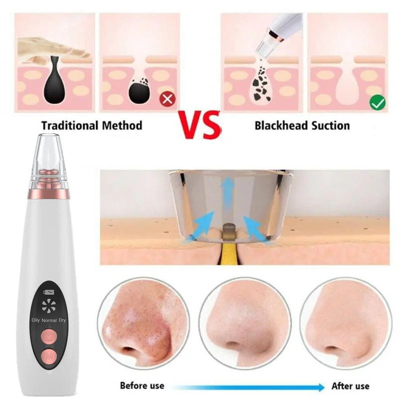 Blackhead Remover Blackheads Remover Pimple Acne Vulgaris Removal Vacuum Suction Removing Blackheads Pore Cleaner Pro Tool USB